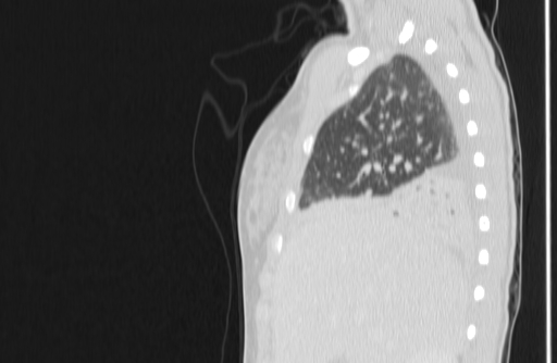 Bronchial mucoepidermoid carcinoma (Radiopaedia 57023-63895 Sagittal lung window 13).jpg