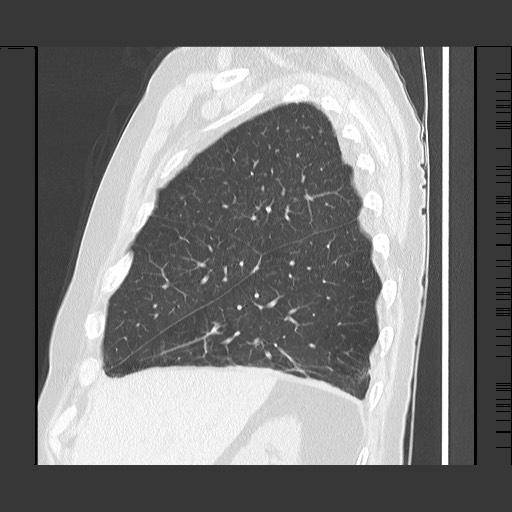 Bronchial stenosis - lung transplant (Radiopaedia 73133-83848 Sagittal lung window 19).jpg