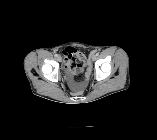 File:Bronchiectasis in Crohn disease (Radiopaedia 60311-67977 B 164).jpg