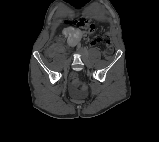 File:Bronchiectasis in Crohn disease (Radiopaedia 60311-67977 Coronal bone window 6).jpg