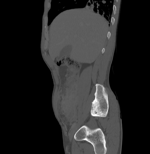 Bronchiectasis in Crohn disease (Radiopaedia 60311-67977 Sagittal bone window 50).jpg