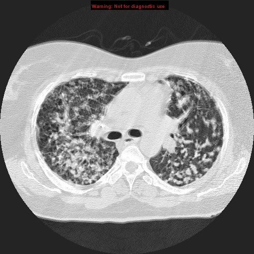 File:Bronchoalveolar carcinoma (Radiopaedia 13224-13233 B 4).jpg