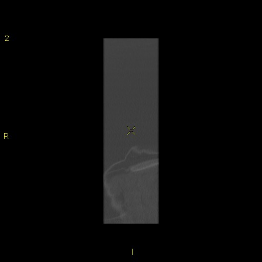 File:Bronchogenic carcinoma as an incidental finding (Radiopaedia 16453-16130 Coronal lung window 1).jpg