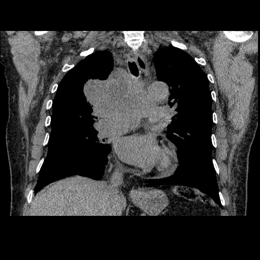 File:Bronchogenic carcinoma with metastatic lymphadenopathy (Radiopaedia 37671-39569 Coronal non-contrast 24).jpg