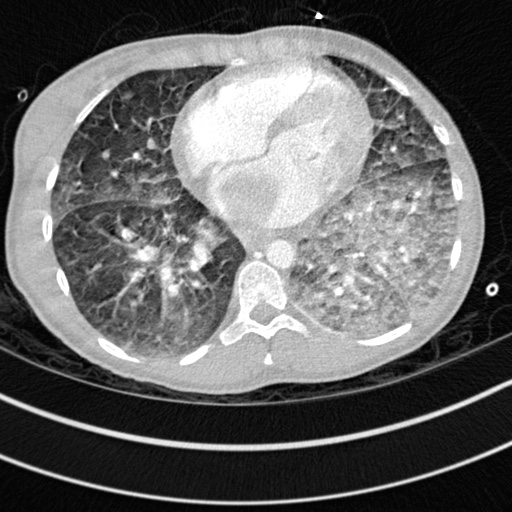 File:Bronchogenic cyst (Radiopaedia 77801-90071 Axial lung window 56).jpg
