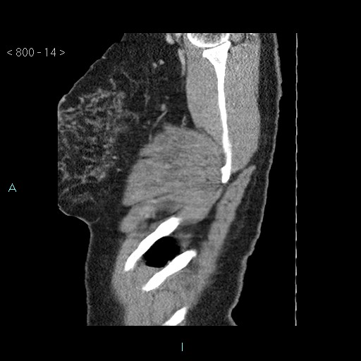 File:Bronchogenic cyst - posterior mediastinal (Radiopaedia 43885-47364 B 9).jpg