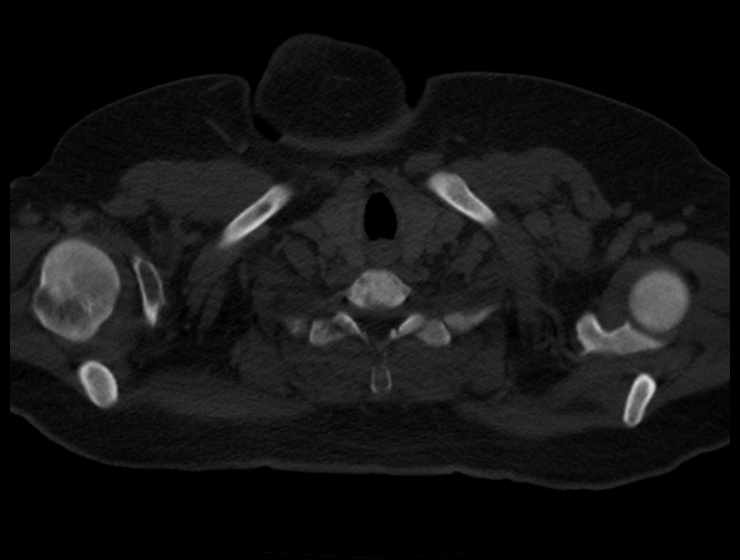 Brown tumors compressing the spinal cord (Radiopaedia 68442-77988 Axial bone window 3).jpg
