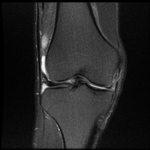 File:Bucket handle tear - medial meniscus (Radiopaedia 69245-79026 Coronal PD fat sat 9).jpg