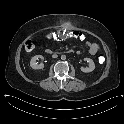 File:Buried bumper syndrome - gastrostomy tube (Radiopaedia 63843-72577 Axial Inject 47).jpg