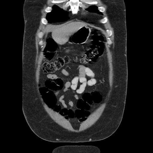 File:Burned-out testicular seminoma - retroperitoneal nodal metastases (Radiopaedia 62872-71245 B 14).jpg