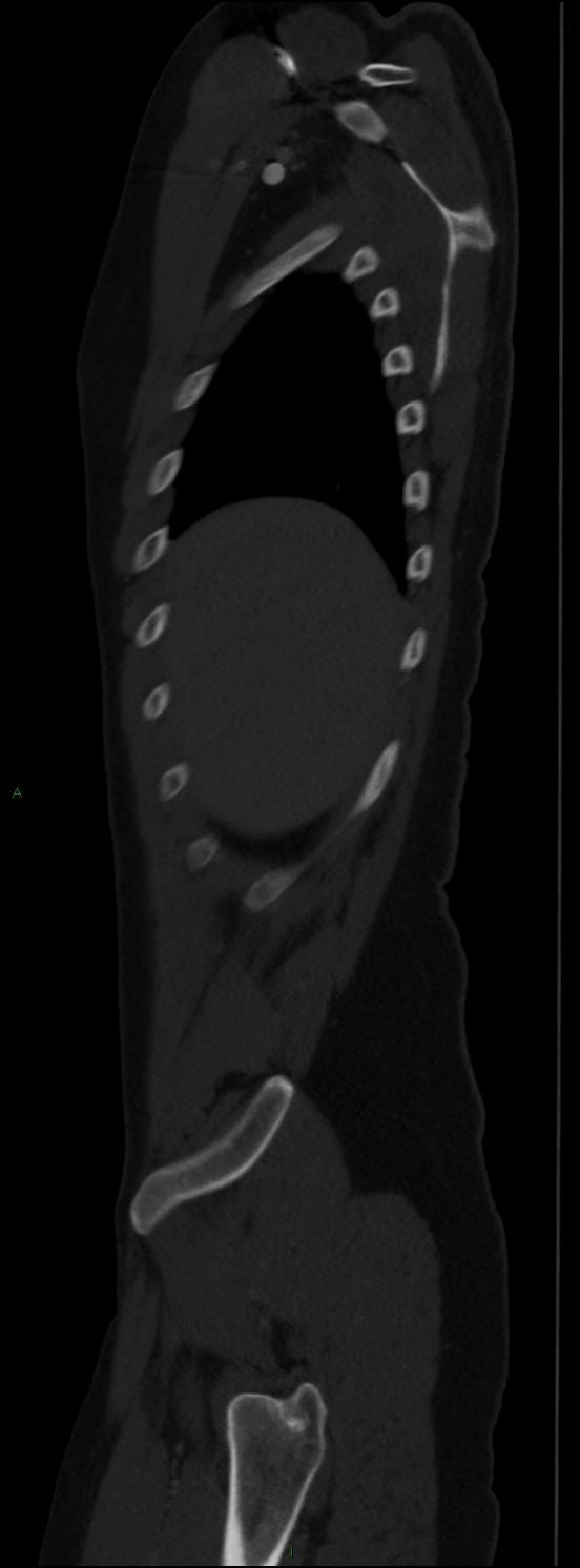 Burst fracture (Radiopaedia 83168-97542 Sagittal bone window 30).jpg