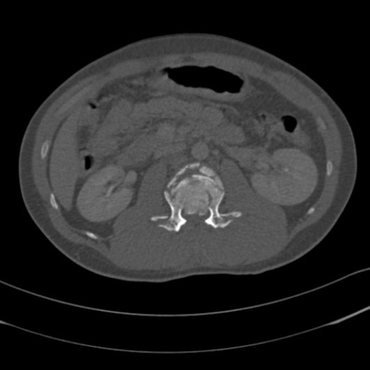 Burst fracture with cauda equina syndrome (Radiopaedia 25701-25867 Axial bone window 37).jpg