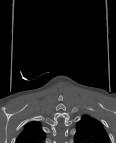 Butterfly vertebra (Radiopaedia 77903-90209 Coronal bone window 102).jpg