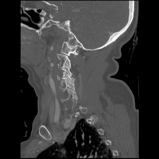 File:C1 anterior arch (plough) fracture - type 1 (Radiopaedia 76181-87720 Sagittal bone window 76).jpg