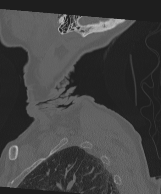C2 fracture with vertebral artery dissection (Radiopaedia 37378-39199 Sagittal bone window 7).png