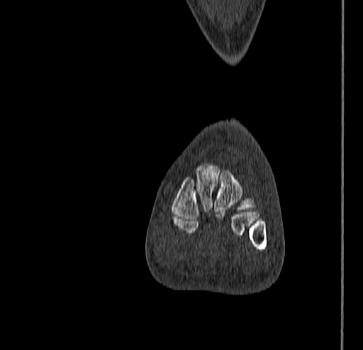 Calcaneal fracture - Sanders type 4 (Radiopaedia 90179-107370 Coronal bone window 45).jpg