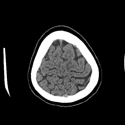 Calcified cerebral hydatid cyst (Radiopaedia 65603-74717 Axial non-contrast 70).jpg