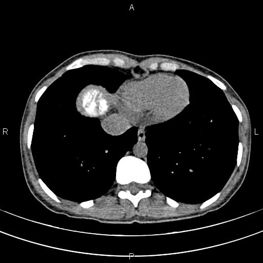 File:Calcified hepatic hydatid cyst (Radiopaedia 83870-99072 Axial non-contrast 9).jpg