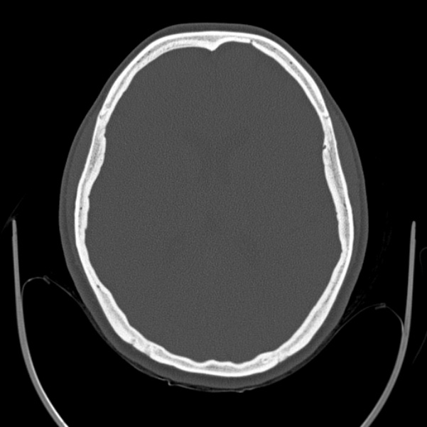 Calvarial osteoma (Radiopaedia 36520-38079 Axial bone window 61).jpg