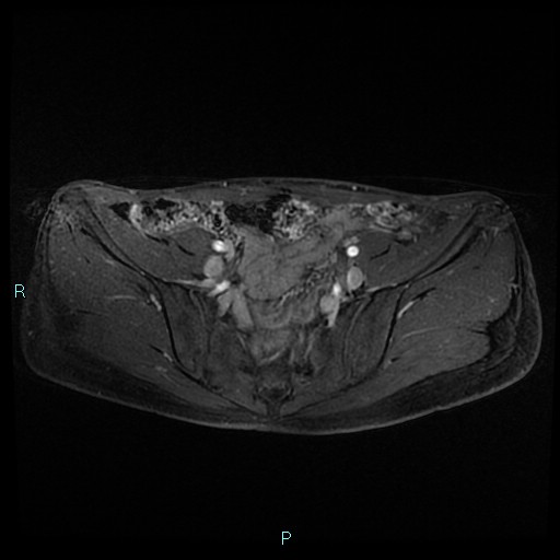 File:Canal of Nuck cyst (Radiopaedia 55074-61448 Axial T1 C+ fat sat 15).jpg