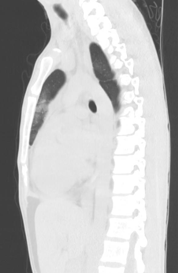 Cannabis-induced diffuse alveolar hemorrhage (Radiopaedia 89834-106946 Sagittal lung window 74).jpg