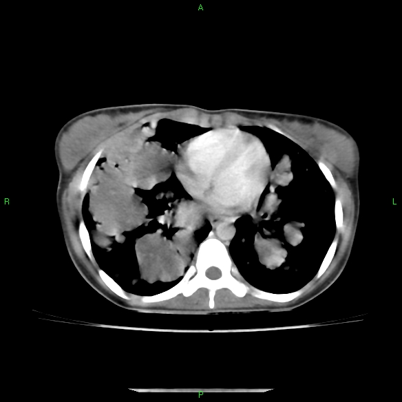 File:Cannon ball metastases - synovial sarcoma (Radiopaedia 26135-26271 C 22).jpg