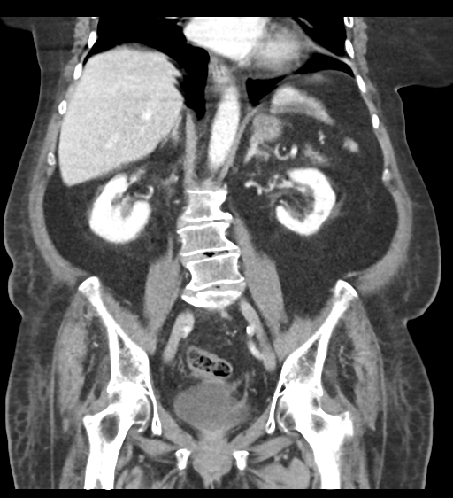 Cannonball metastases from endometrial cancer (Radiopaedia 42003-45031 F 41).png