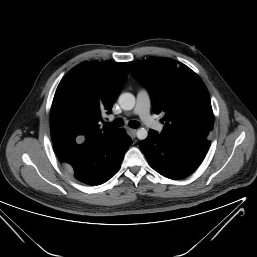File:Cannonball pulmonary metastases (Radiopaedia 67684-77101 D 115).jpg