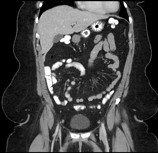 Carcinoid tumor - terminal ileum (Radiopaedia 60931-68739 B 21).jpg