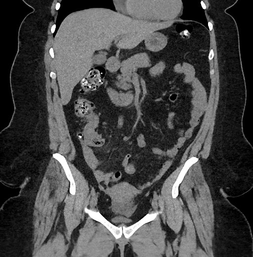 Carcinoid tumor - terminal ileum (Radiopaedia 60931-68740 Coronal non-contrast 38).jpg