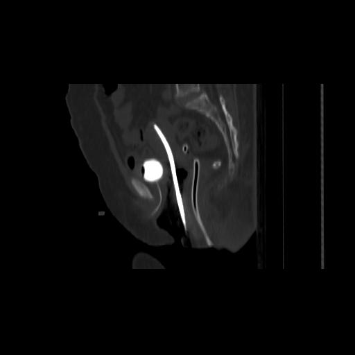 Carcinoma cervix- brachytherapy applicator (Radiopaedia 33135-34173 Sagittal bone window 87).jpg