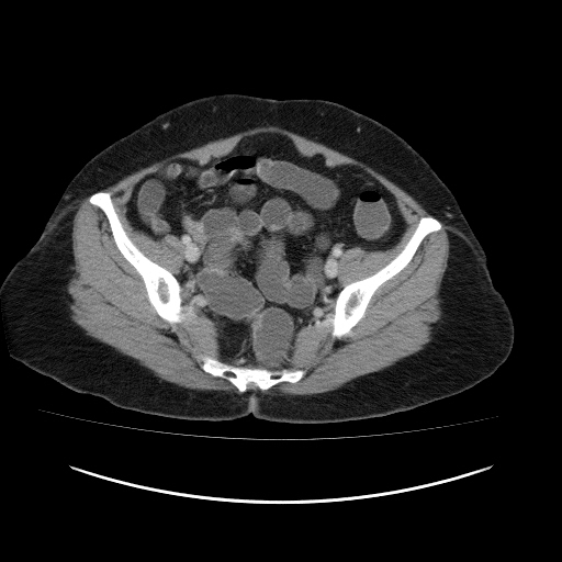 File:Carcinoma colon - hepatic flexure (Radiopaedia 19461-19493 A 105).jpg