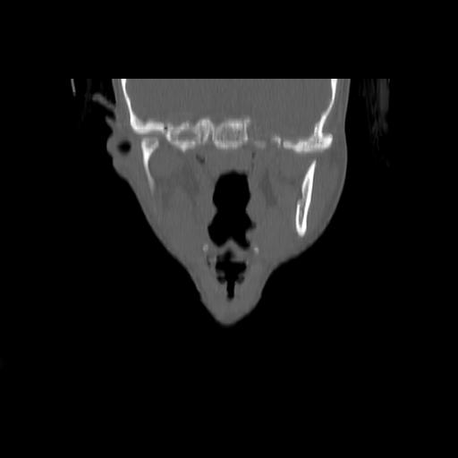 Carcinoma of the maxillary antrum (Radiopaedia 53805-59888 Coronal bone window 78).jpg