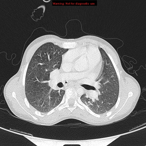File:Cardiac bronchus (Radiopaedia 14059-13899 A 17).jpg