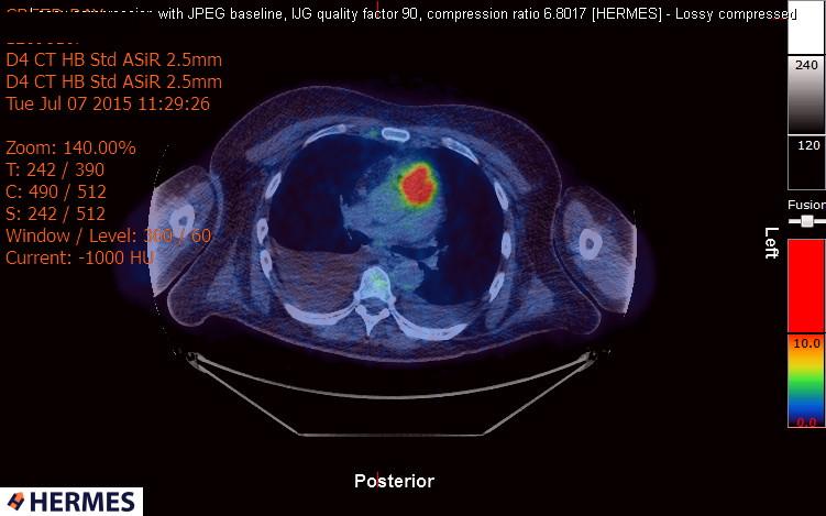 File:Cardiac lymphoma (Radiopaedia 38690-40871 Integrated PET-CT 7).jpg