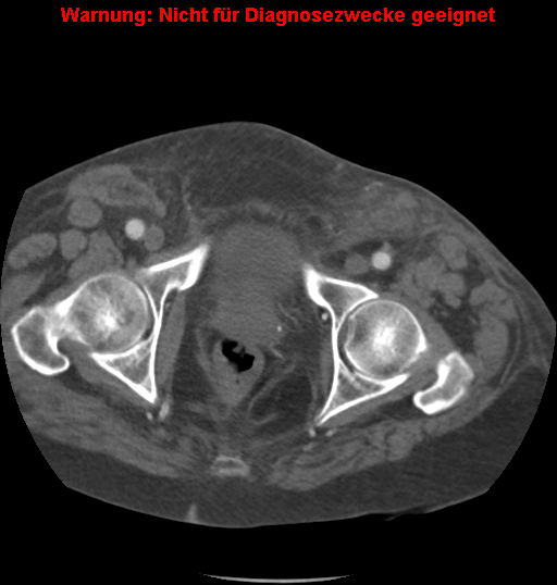 File:Cardiac perforation following transcatheter aortic valve implantation (Radiopaedia 23714-23863 B 8).png