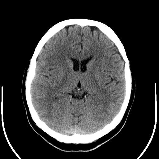File:Carotico ophthalmic aneurysm (Radiopaedia 42916-46147 Axial non-contrast 12).png