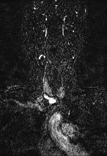 Carotid artery dissection (Radiopaedia 28441-28689 Coronal MRA 14).jpg