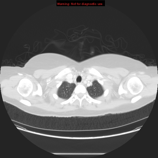 Carotid body tumor with lung metastases (Radiopaedia 9301-48390 Axial lung window 14).jpg