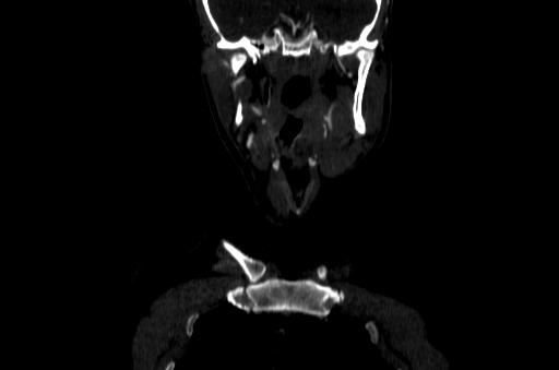 File:Carotid bulb pseudoaneurysm (Radiopaedia 57670-64616 D 2).jpg