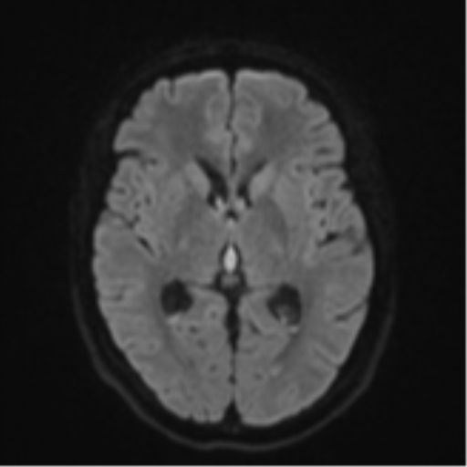 File:Cavernoma with bleed - midbrain (Radiopaedia 54546-60774 Axial DWI 41).png