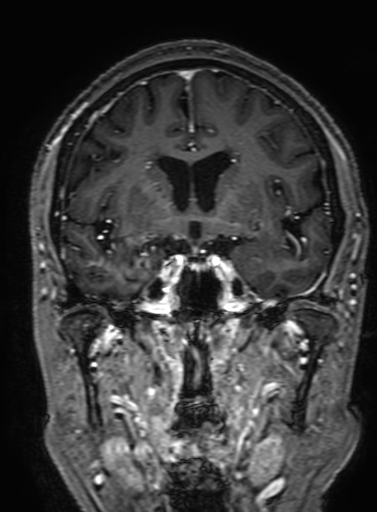Cavernous hemangioma of the cerebellar falx (Radiopaedia 73025-83724 Coronal T1 C+ 160).jpg