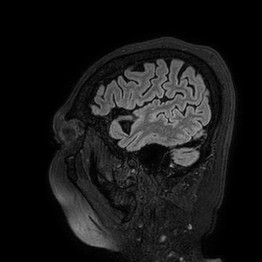 Cavernous hemangioma of the cerebellar falx (Radiopaedia 73025-83724 Sagittal FLAIR 25).jpg