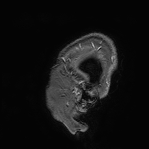 Cavernous hemangioma of the cerebellar falx (Radiopaedia 73025-83724 Sagittal T1 C+ 5).jpg
