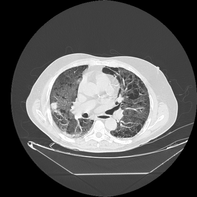 Cavitating bronchogenic carcinoma (Radiopaedia 44489-48162 Axial lung window 41).jpg