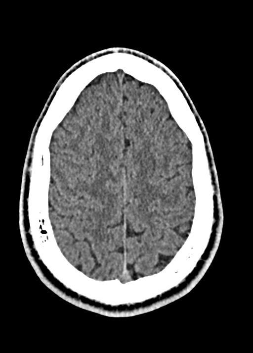 Cavum septum pellucidum and cavum vergae (Radiopaedia 77797-90060 Axial Brain Window 83).jpg
