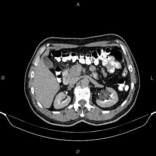 Cecal adenocarcinoma (Radiopaedia 85324-100916 Axial C+ delayed 33).jpg