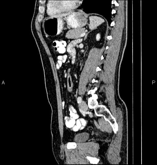 Cecal adenocarcinoma (Radiopaedia 85324-100916 E 57).jpg