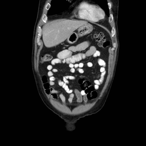 Cecal mass causing appendicitis (Radiopaedia 59207-66531 B 11).jpg