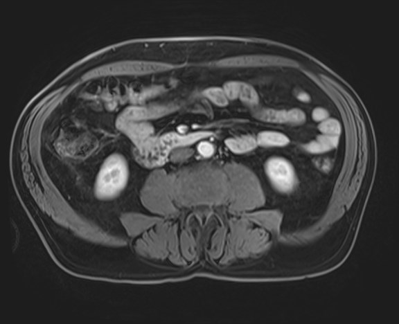 Cecal mass causing appendicitis (Radiopaedia 59207-66532 H 76).jpg